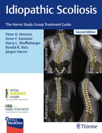 Idiopathic Scoliosis