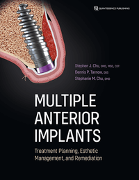 Multiple Anterior Implants