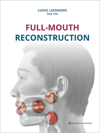 Full-Mouth Reconstruction