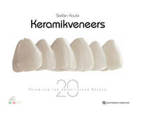 Keramikveneers